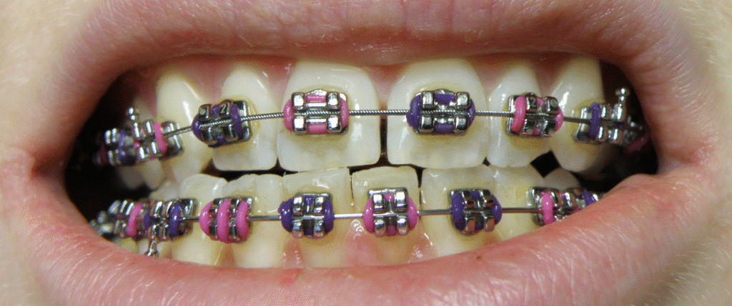 Orthodontic Treatment (দাঁতের সোজা করার চিকিৎসা) 3 image 2