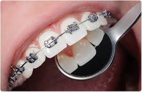 Orthodontic Treatment (দাঁতের সোজা করার চিকিৎসা) 2 image 4
