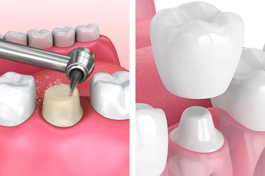 দাঁতের পুনর্গঠন (Dental Reconstruction) (Mirpur-10) 3 image 7