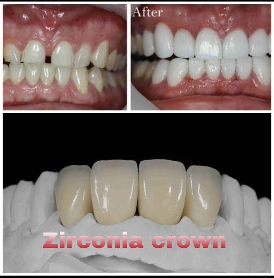 Zirconia Crown