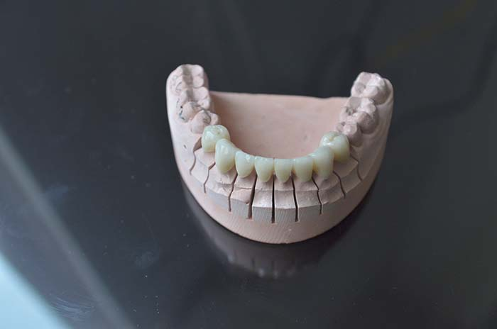 জিরকোনিয়া ক্যাপ (Zirconia Crown): আধুনিক দাঁতের চিকিৎসায় সৌন্দর্য ও স্থায়িত্বের সম্মিলন 2 image 14