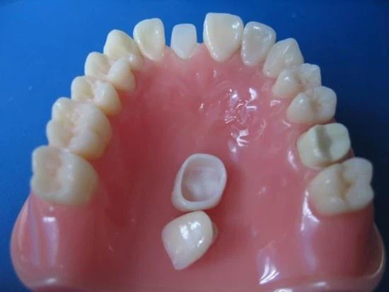 জিরকোনিয়া ক্যাপ (Zirconia Crown): আধুনিক দাঁতের চিকিৎসায় সৌন্দর্য ও স্থায়িত্বের সম্মিলন 4 image 15