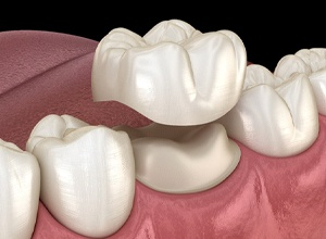 Ceramic Crown