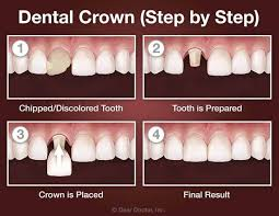 অল-সেরামিক ক্যাপ (All-Ceramic Crown): একটি আধুনিক, প্রাকৃতিক ও টেকসই সমাধান 4 image 22
