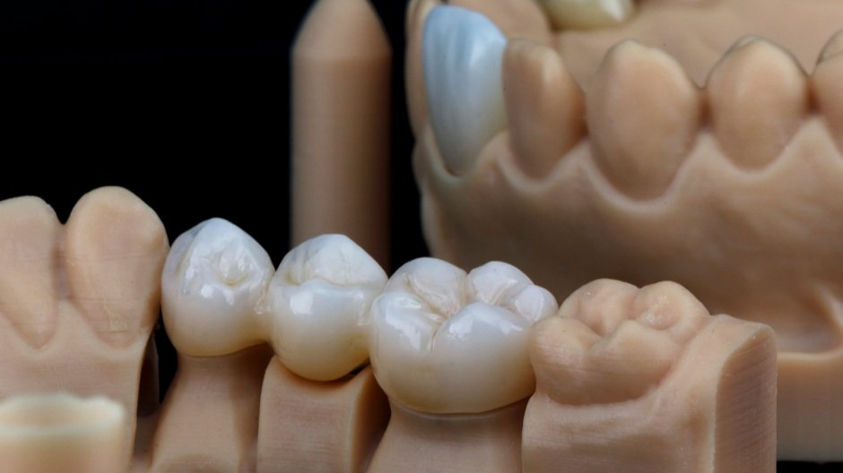 রেজিন ক্যাপ (Resin Crown)