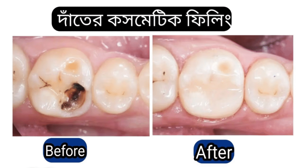 Cosmetic Dental Filling