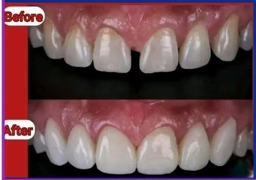 কসমেটিক ফিলিং(Cosmetic Dental Filling)দাঁতের সৌন্দর্য ও সুস্থতায় আধুনিক সমাধান 3 image 31