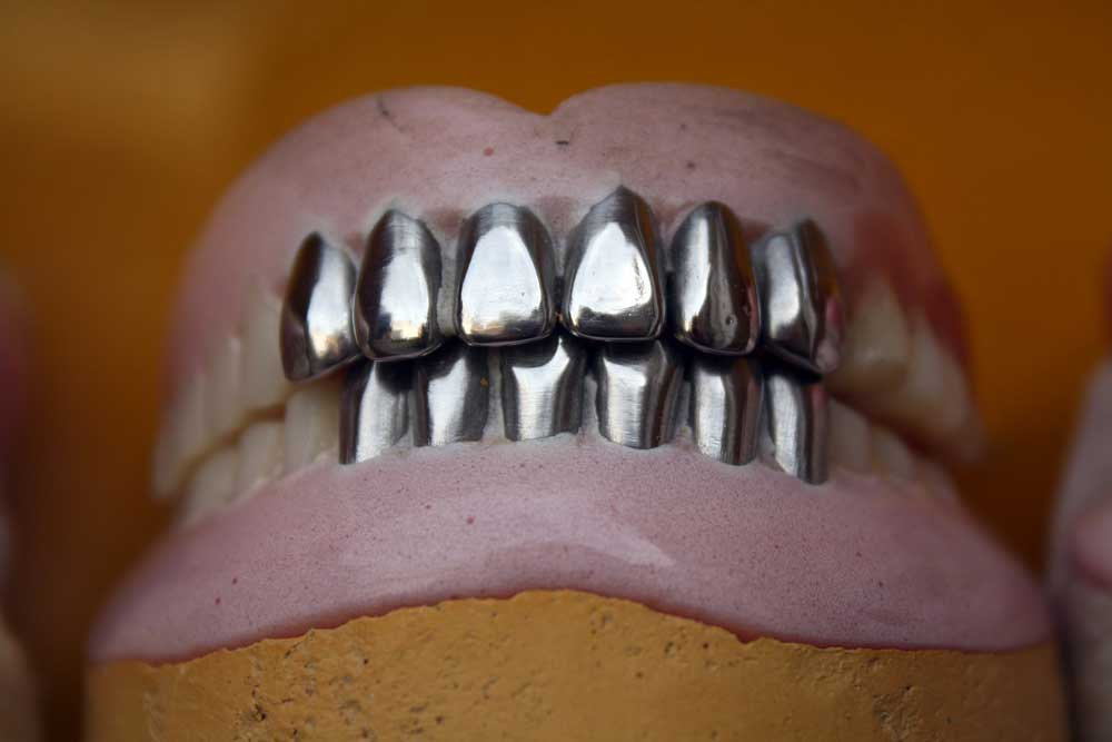 মেটাল ক্যাপ (Metal Crown): দাঁতের রক্ষাকারী ঢাল