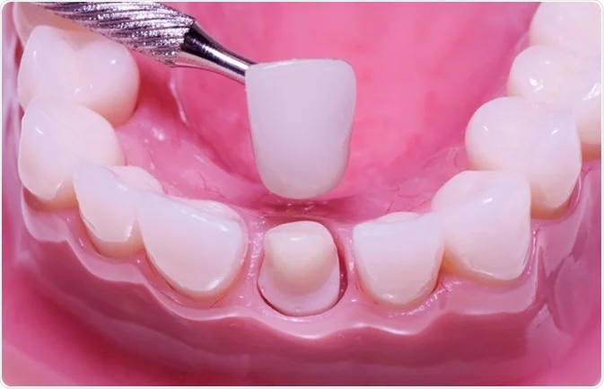 Dental Crown