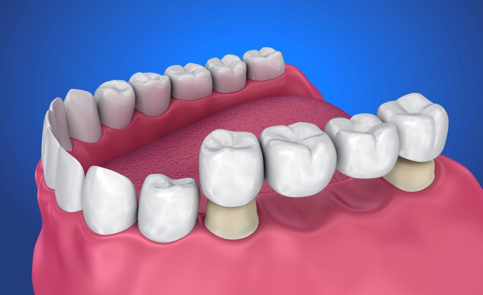Dental Bridge