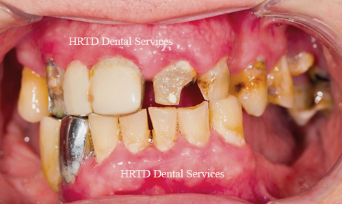 Dental Diseases 1 Dental Diseases