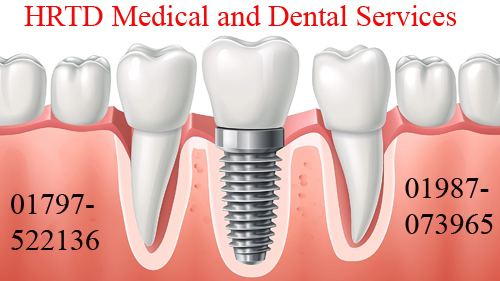 Dental Implant Image