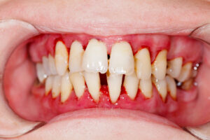 Periodontal Diseases