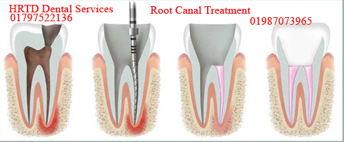 HRTD Medical & Dental Services 2 Root Canal Treatment