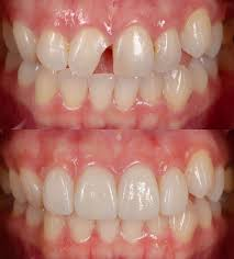 Composite Filling 1 image 33