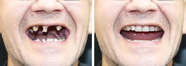 Treatment of Tooth Loss