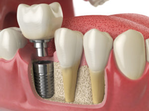 Best Treatment of Tooth Loss