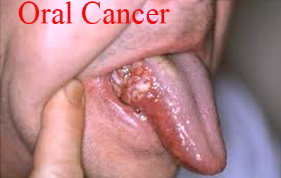 Oral Cancer