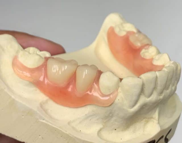 Partial Flexible Denture 2 image 21