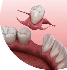 Immediate Flexible Denture