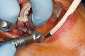 Oral Surgery 2 image 44