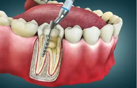 Root Canal Treatment (RCT) 3 Root Canal Treatment (RCT)